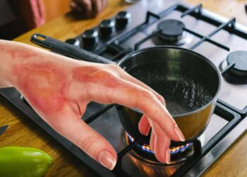 cosa mettere sulla bruciatura